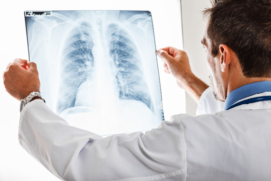 Lung Cancer Screening