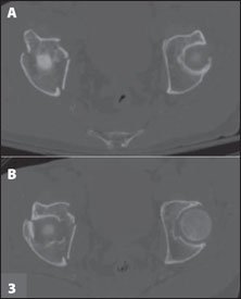 Axial CT cuts