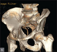 CT reconstruction of pelvis