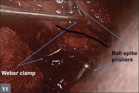 Placement of reduction instruments