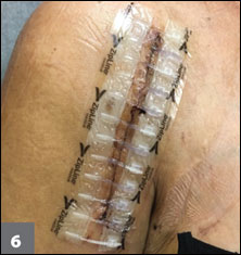 shoulder arthroplasty incision with closure device
