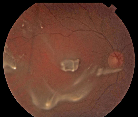 Triamcinolone in posterior vitreous following an anterior vitrectomy.