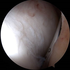 arthroscopic findings of cartilage wear