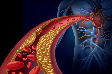 Artery Plaque