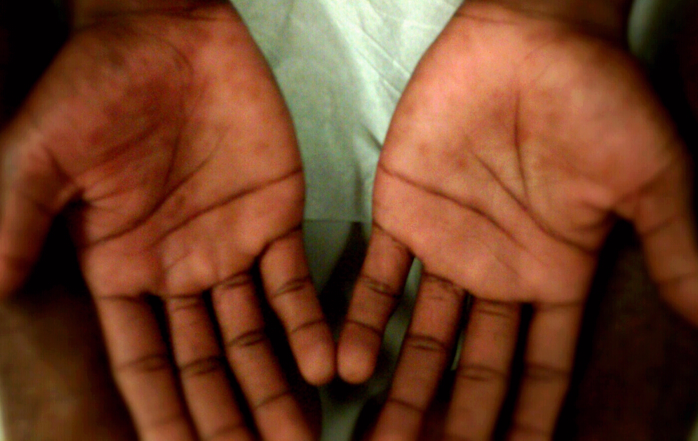 Case A 16yearold male complains of a rash on both hands