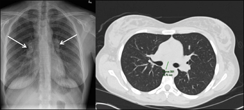 Chest x-ray