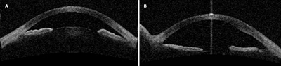 Anterior segment OCT