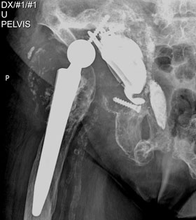 Pelvis defect